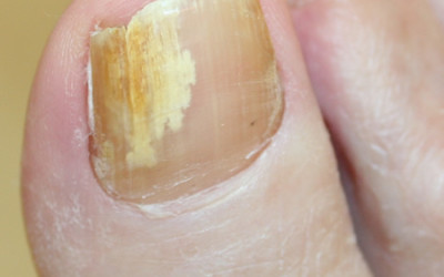 Uh oh.. Do your nails look like this?