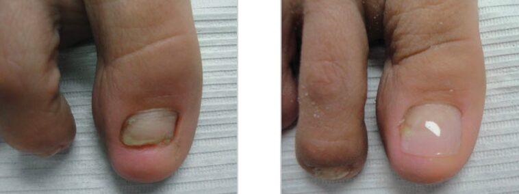 A big toenail before reconstruction, damaged and partly missing, and after, with a smooth natural-looking resin nail